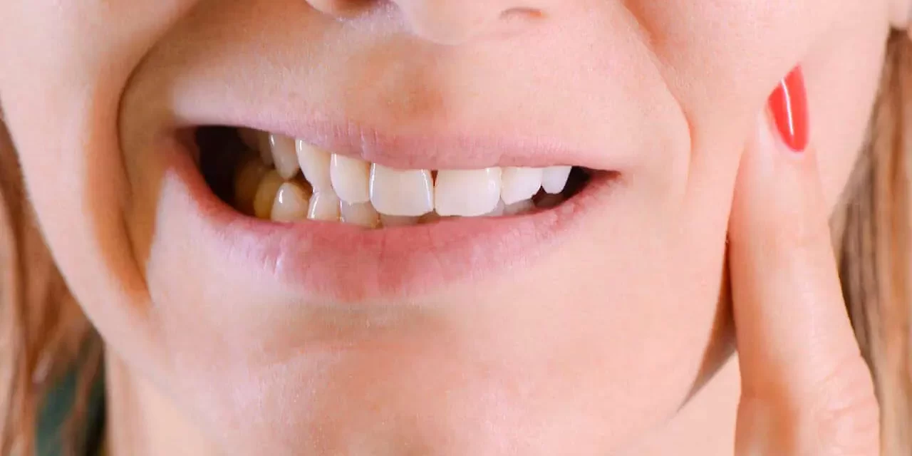 Digrigno i denti.. Posso mettere delle faccette sui denti anteriori